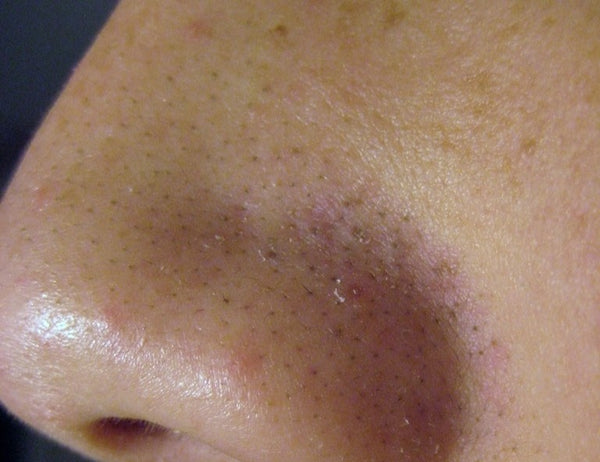 Pores visibles et impuretés